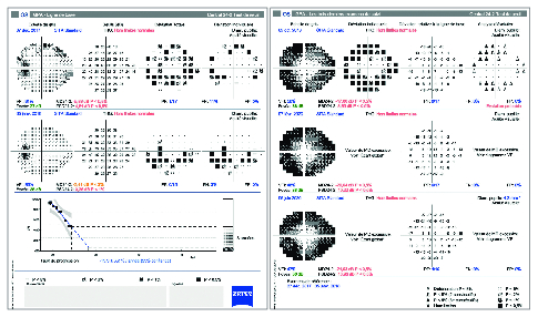 Les symptômes associés aux syndromes des taches blanches : photopsies et anomalies du champ visuel - Figure 5