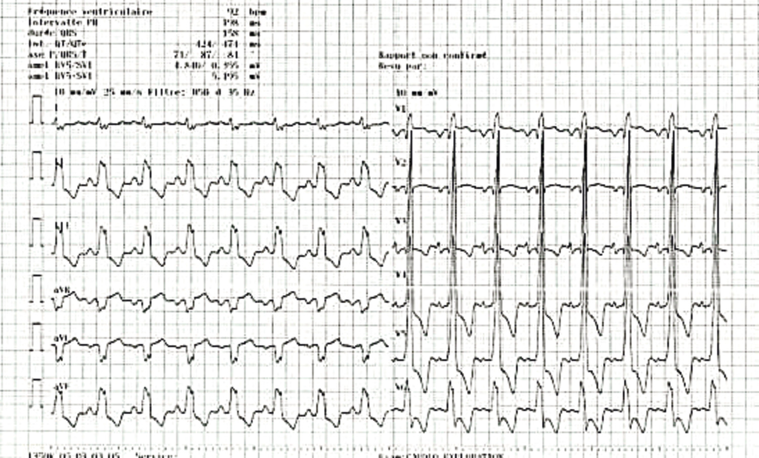 Cœur triatrial et syndrome coronarien aigu - Figure 1