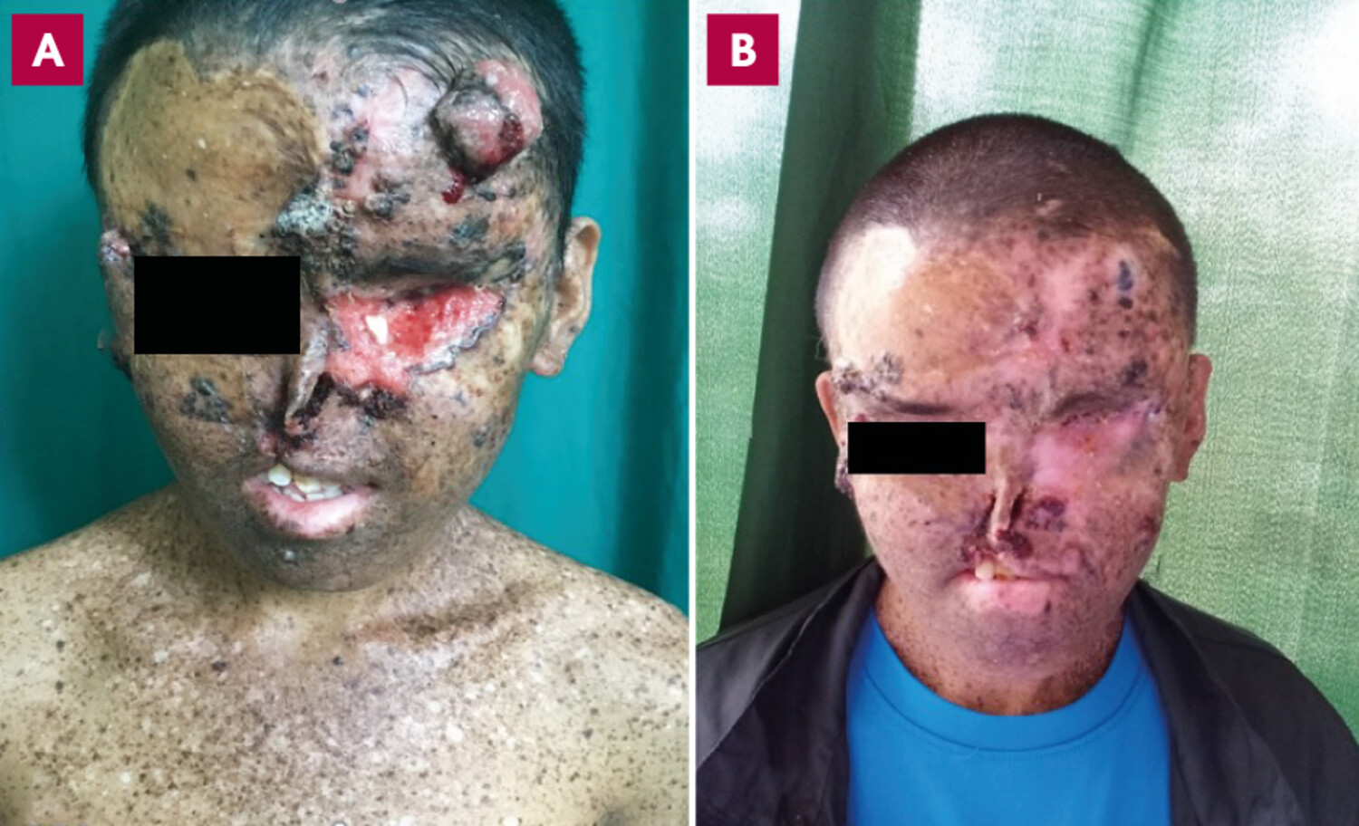 Xeroderma pigmentosum au Népal : souffrance et traumatismes d’une peau non réparée - Figure 3