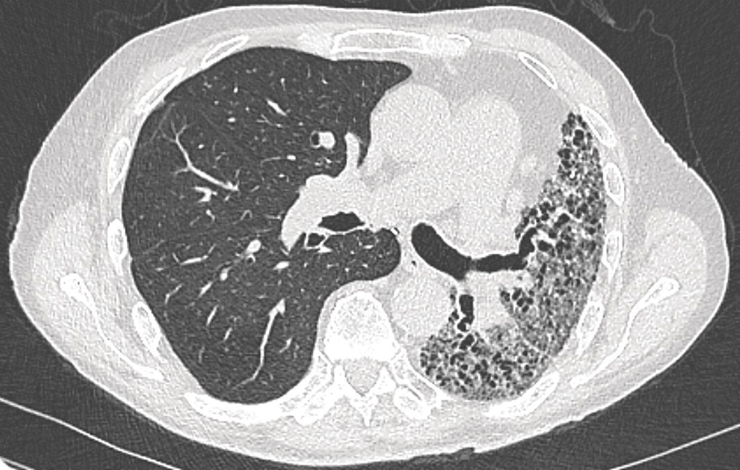 Transplantation pulmonaire chez les patients atteints de pneumopathie interstitielle diffuse - Figure