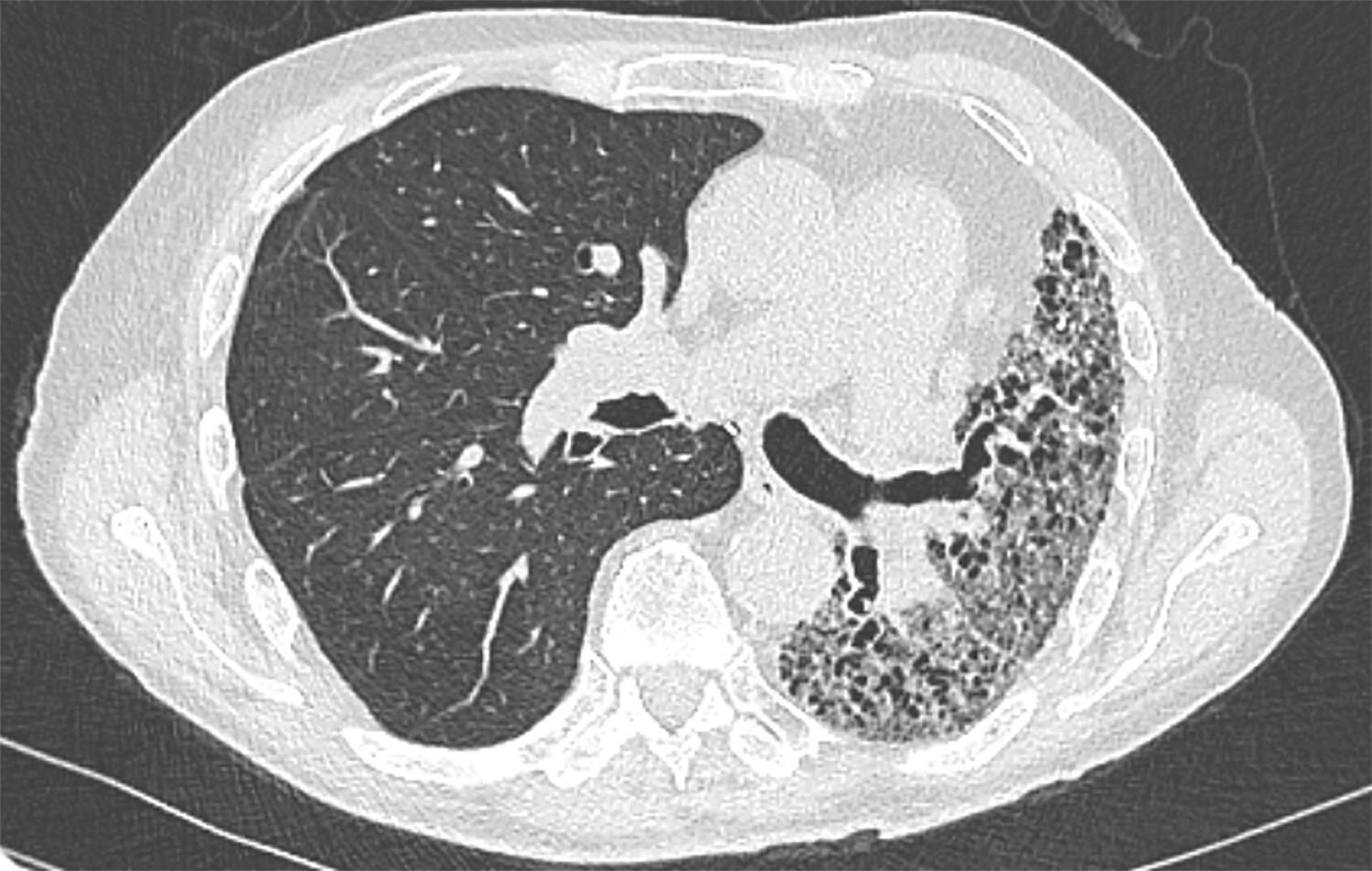 Transplantation ­pulmonaire chez les patients atteints de ­pneumopathie interstitielle diffuse - Figure