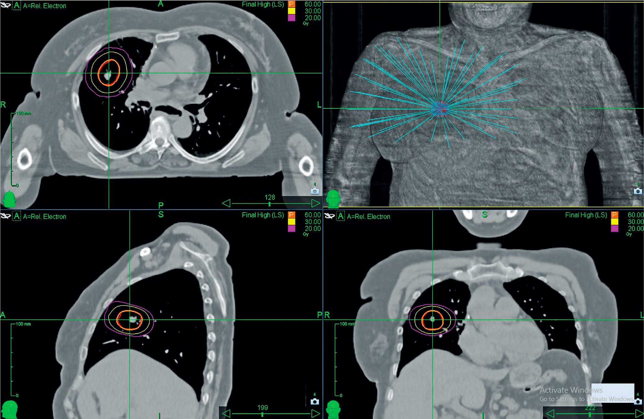 La radiothérapie en conditions ­stéréotaxiques pulmonaire en pratique - Figure 2