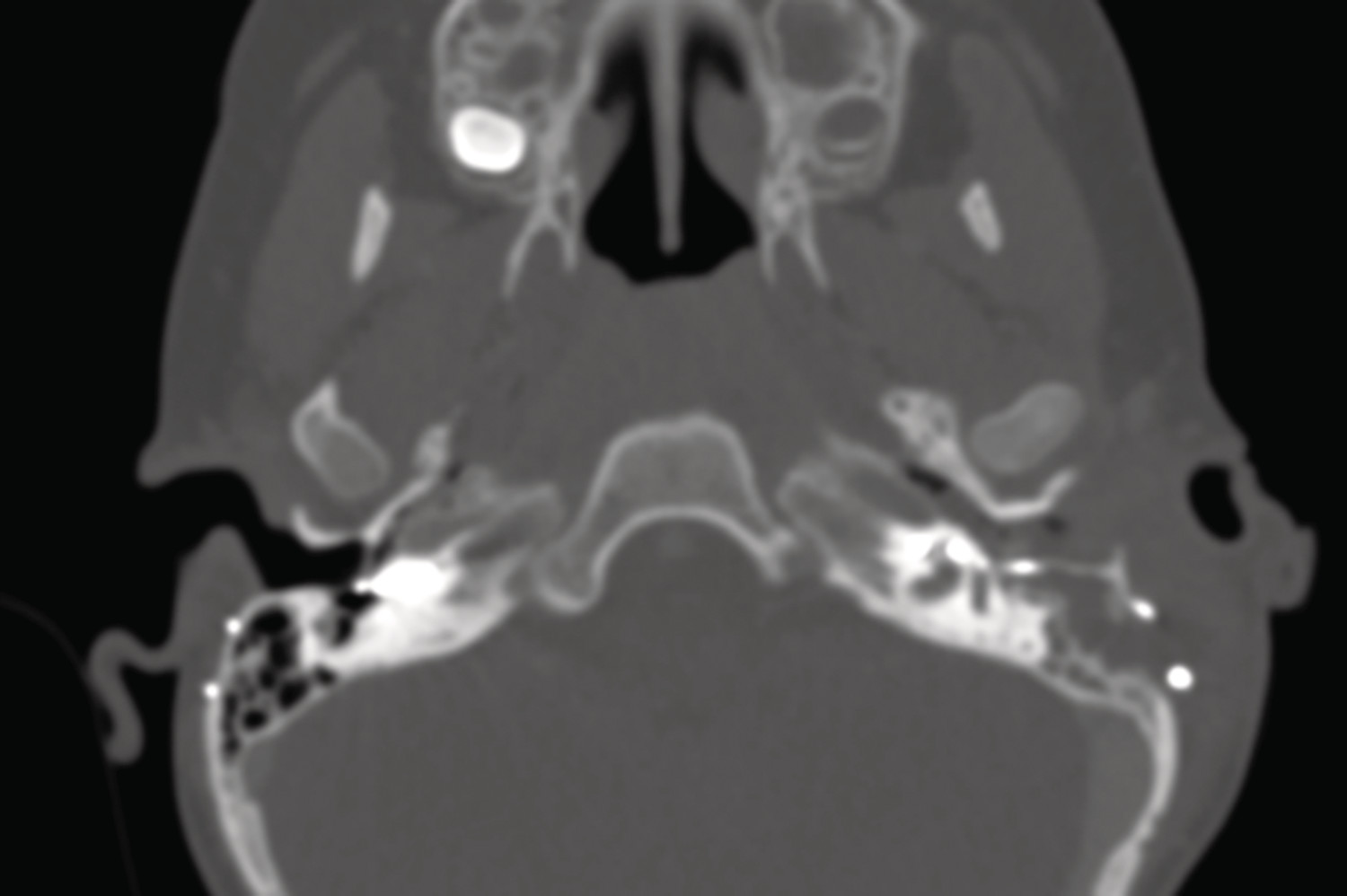 Mastoïdite aiguë sur implant cochléaire chez un enfant - Figure 3
