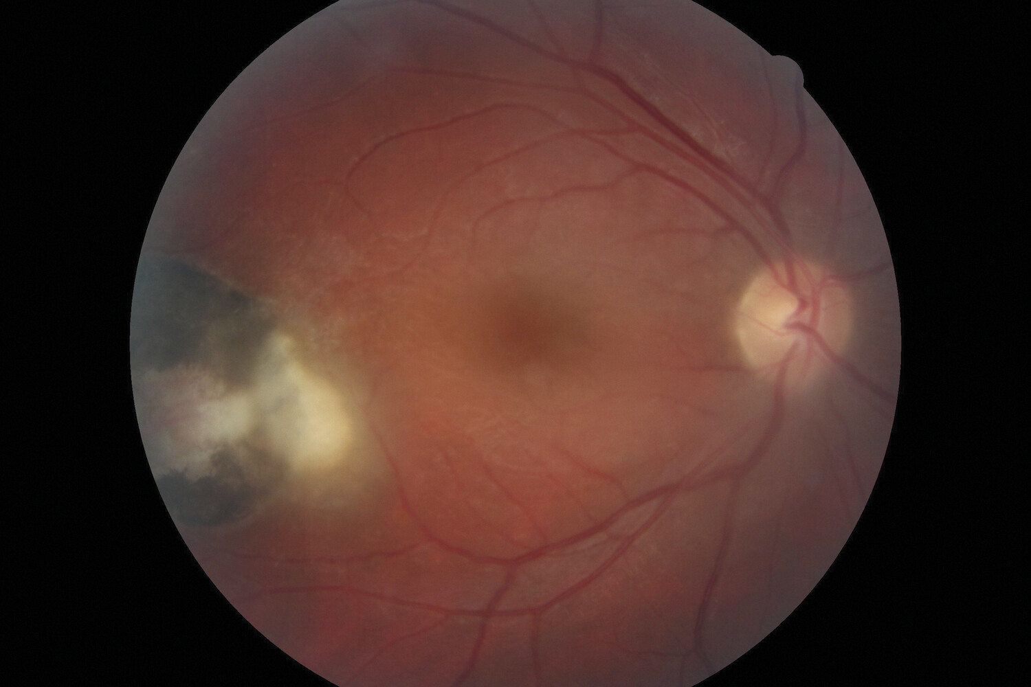Toxoplasmose oculaire : prise en charge des formes récurrentes avec menace visuelle - Figure 1