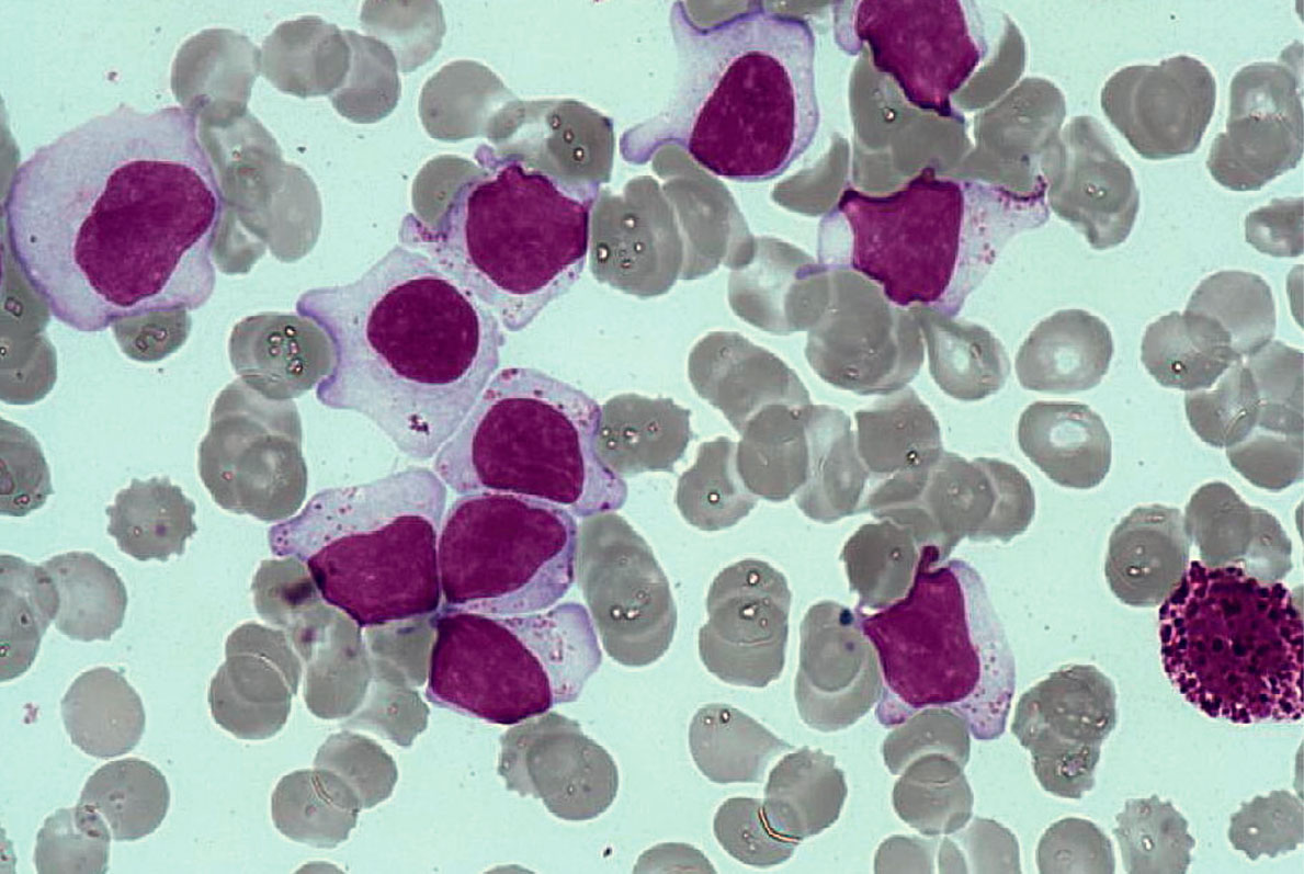Leucémies à grands lymphocytes granuleux : quoi de neuf en 2021 ? - Figure 1
