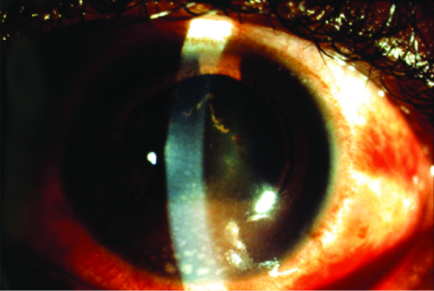 Atteintes oculaires de la syphilis acquise - Figure 1