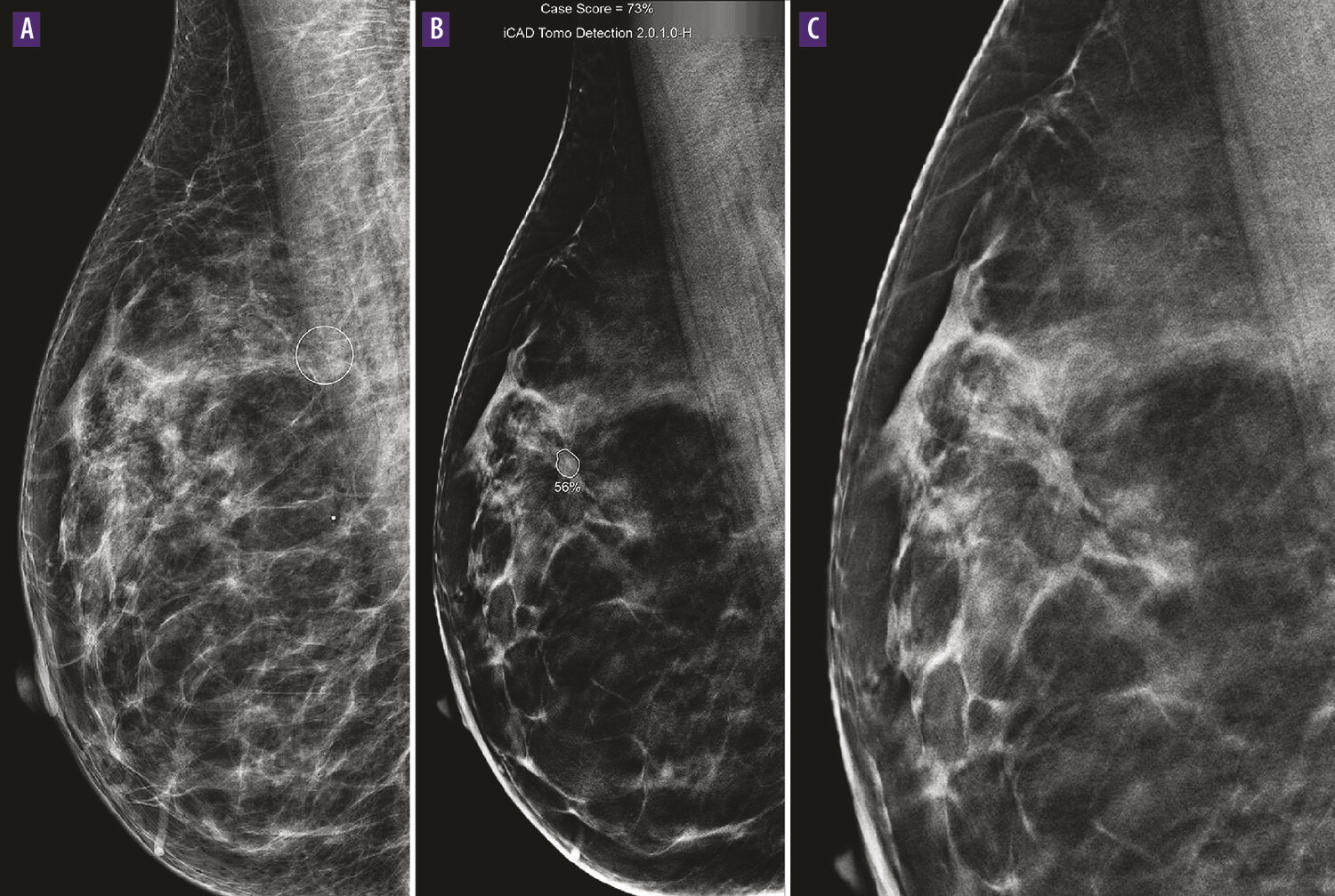 Intelligence artificielle en mammographie et dépistage du cancer du sein - Figure 4