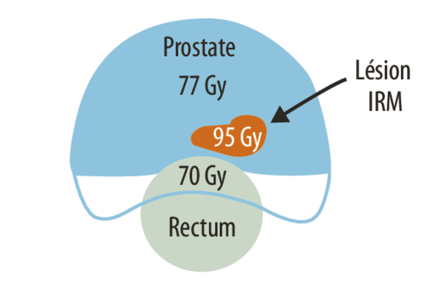 Essai FLAME : bénéfice d’une augmentation de la dose d’irradiation dans le cancer de la prostate localisé - Figure 1