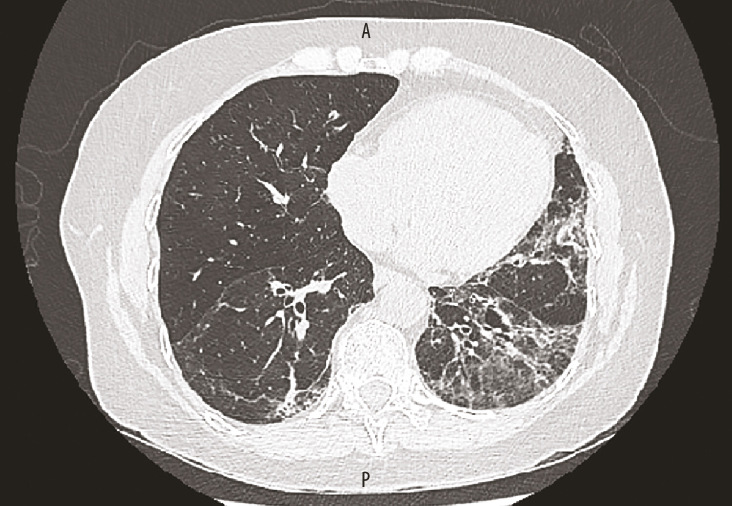 Lupus érythémateux systémique et poumon - Figure 2