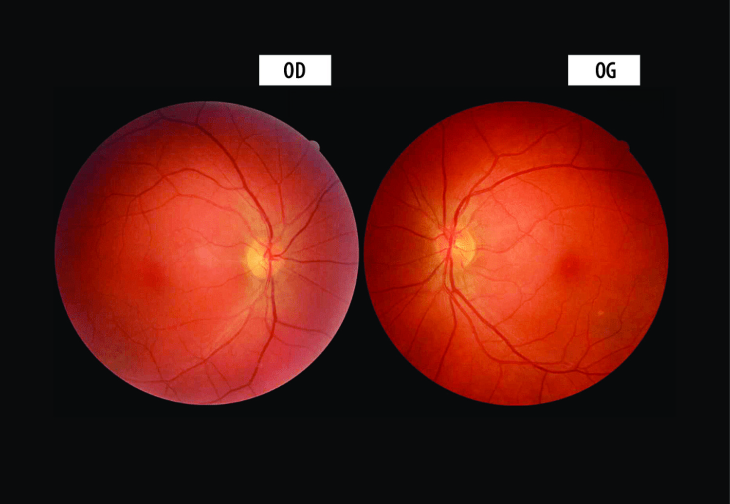 Baisse d’acuité visuelle indolore chez un jeune adulte : penser à la neuropathie optique héréditaire de Leber  - Figure 2