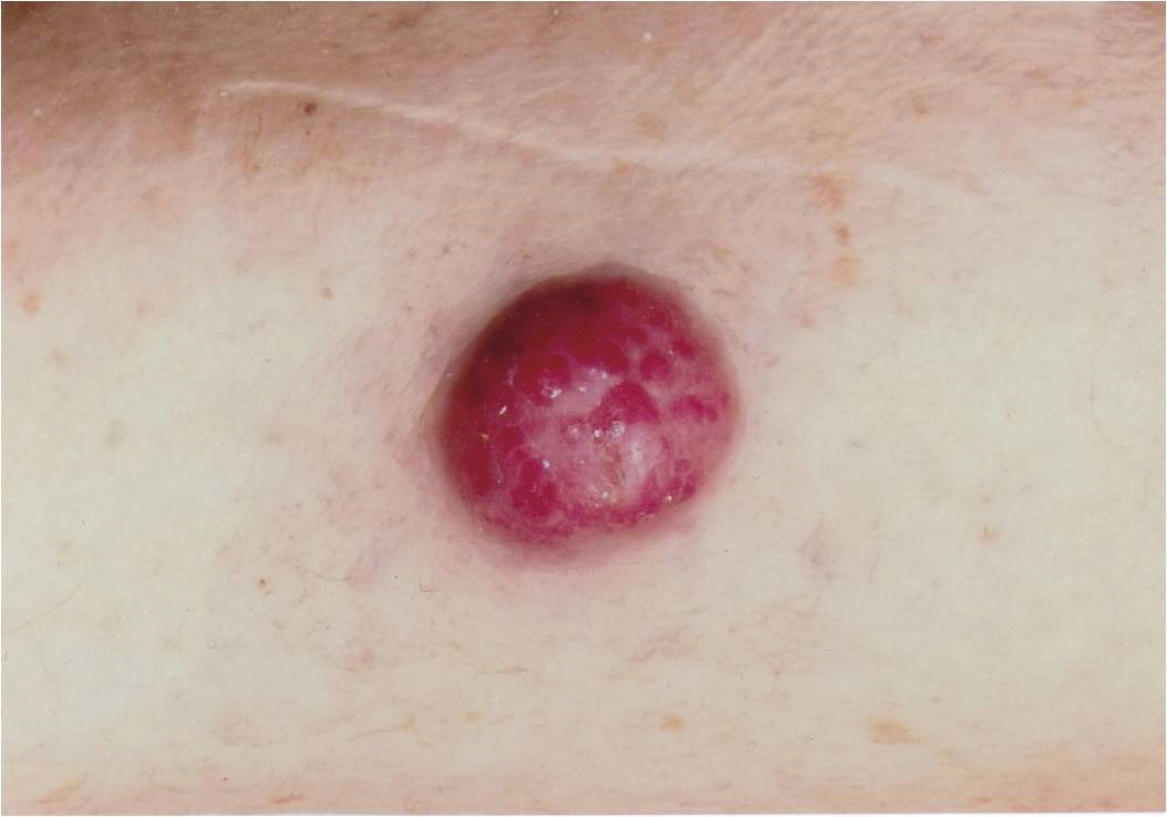 Cancers cutanés et traitements immunomodulateurs utilisés en rhumatologie et en dermatologie - Figure 4